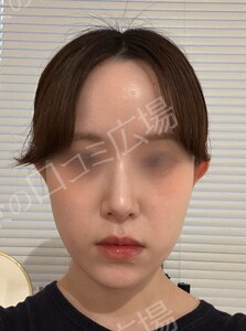 貴族手術（鼻翼基部プロテーゼ）｜ほうれい線を改善の治療前の症例写真
