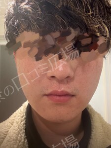 治療直後の症例写真