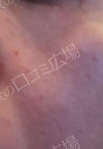 治療直後の症例写真