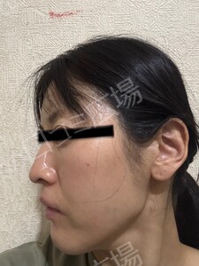 治療直後の症例写真