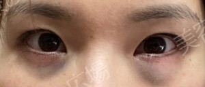 治療直後の症例写真