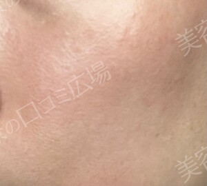 治療直後の症例写真