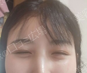 【おすすめ！】　涙袋ヒアルロン酸（0.1㏄）の治療直後の症例写真