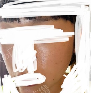 治療直後の症例写真