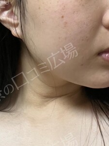 治療直後の症例写真