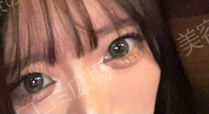 治療直後の症例写真