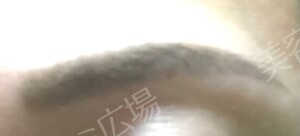 眉アートメイク｜自然な眉の形と濃さの治療結果の症例写真