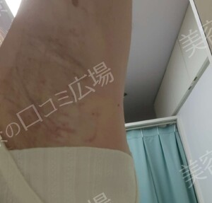ミラドライ 両わき 1回 レベル８＋部分重複照射の治療直後の症例写真
