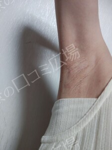 ミラドライ 両わき 1回 レベル８＋部分重複照射の治療結果の症例写真