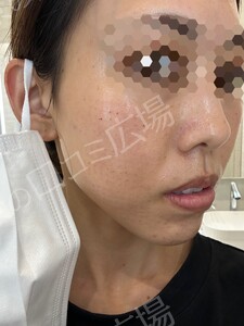 治療直後の症例写真