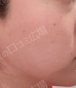 顔脱毛1回｜新宿院：ジェントルマックスプロプラスの治療直後の症例写真