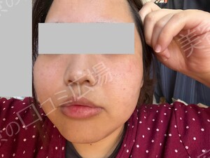 治療直後の症例写真