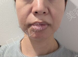 医療ハイフ｜頬・フェイスラインのたるみの治療前の症例写真