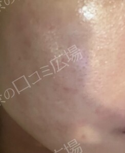 ララドクター｜低刺激ピーリング｜ララピール進化版の治療直後の症例写真
