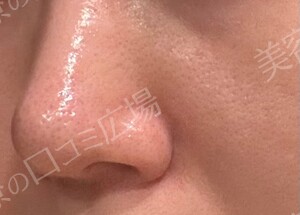 ハイドラジェントル｜毛穴の黒ずみを集中的に除去の治療結果の症例写真