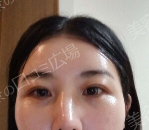 【おすすめ！】　涙袋ヒアルロン酸（0.1㏄）の治療結果の症例写真