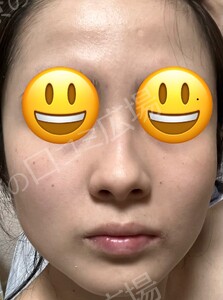 治療直後の症例写真
