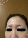 施術後の状態