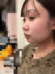 治療直後の症例写真