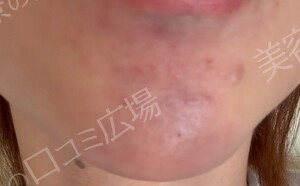 治療直後の症例写真