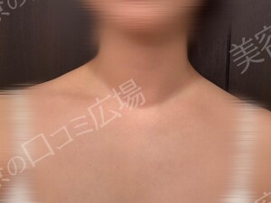 治療直後の症例写真