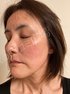 治療直後の症例写真