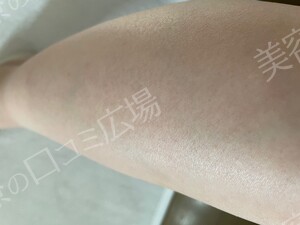 治療直後の症例写真