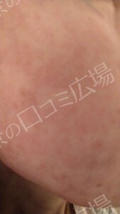 治療前の症例写真