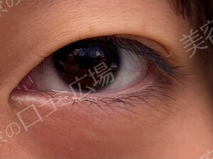 【学生限定】LS法ダブルスタンダードプラン　両目の治療前の症例写真