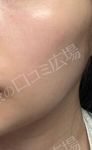 フォトフェイシャルStellar M22の治療直後の症例写真