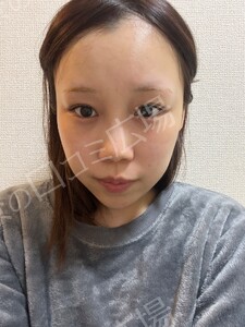 【筒井院長】脱脂術＋ピュアグラフティング　リポキューブの治療結果の症例写真