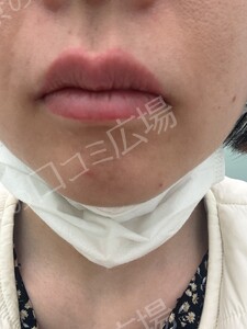 リップ ＆ アイライン上下 アートメイク 2回 モニター施術の治療結果の症例写真