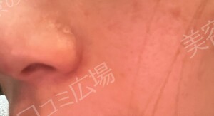 治療直後の症例写真