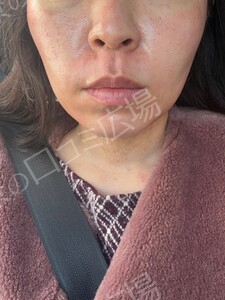 治療直後の症例写真