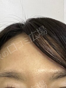 治療結果の症例写真