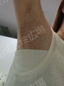 ミラドライ 両わき 1回 レベル８＋部分重複照射の治療直後の症例写真