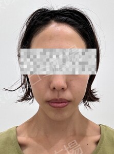 治療直後の症例写真