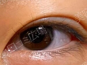 【学生限定】LS法ダブルスタンダードプラン　両目の治療結果の症例写真