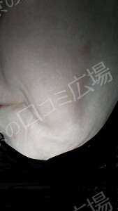 治療直後の症例写真