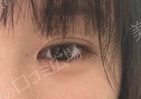 治療直後の症例写真