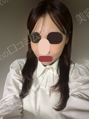 椿クリニックのボトックスの症例写真[ビフォー]