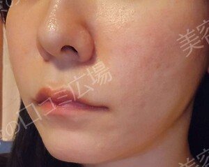 治療直後の症例写真