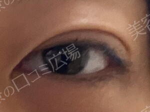 【学生限定】LS法ダブルスタンダードプラン　両目の治療直後の症例写真