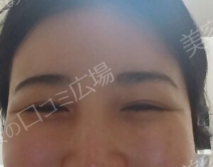 【おすすめ！】　涙袋ヒアルロン酸（0.1㏄）の治療前の症例写真