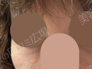 治療直後の症例写真