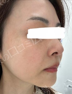 治療直後の症例写真