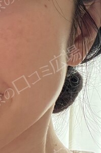 治療直後の症例写真