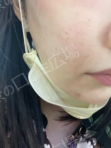 治療結果の症例写真
