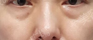 スキンクリニック 掛川院の目元・クマ・眉下・涙袋整形の症例写真[ビフォー]