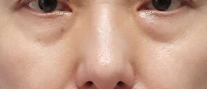 スキンクリニック 掛川院の目元・クマ・眉下・涙袋整形の症例写真[ビフォー]